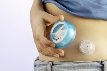 مزایا و معایب سنسور پایش قند خون (CGM)